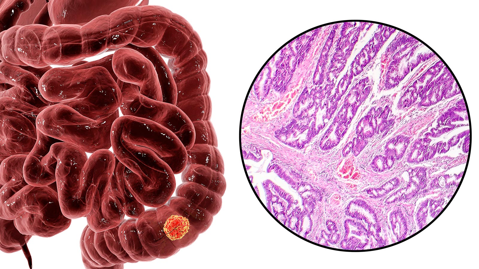 Carne procesada cancerigena